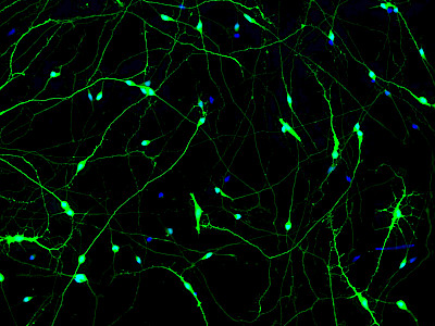 Childhood-onset movement disorders & Hereditary Spastic Paraplegia